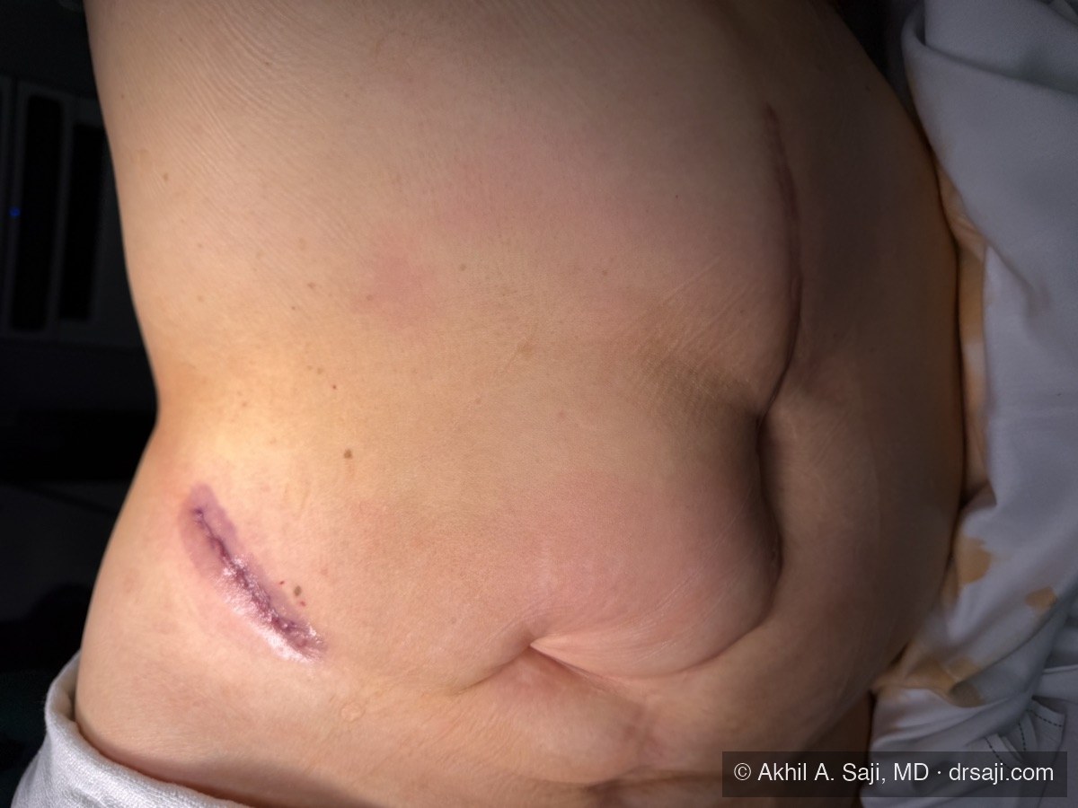 Low anterior access incision on the day of single-port retroperitoneal partial nephrectomy, low on the abdomen beside the patient's larger scars from prior open surgery