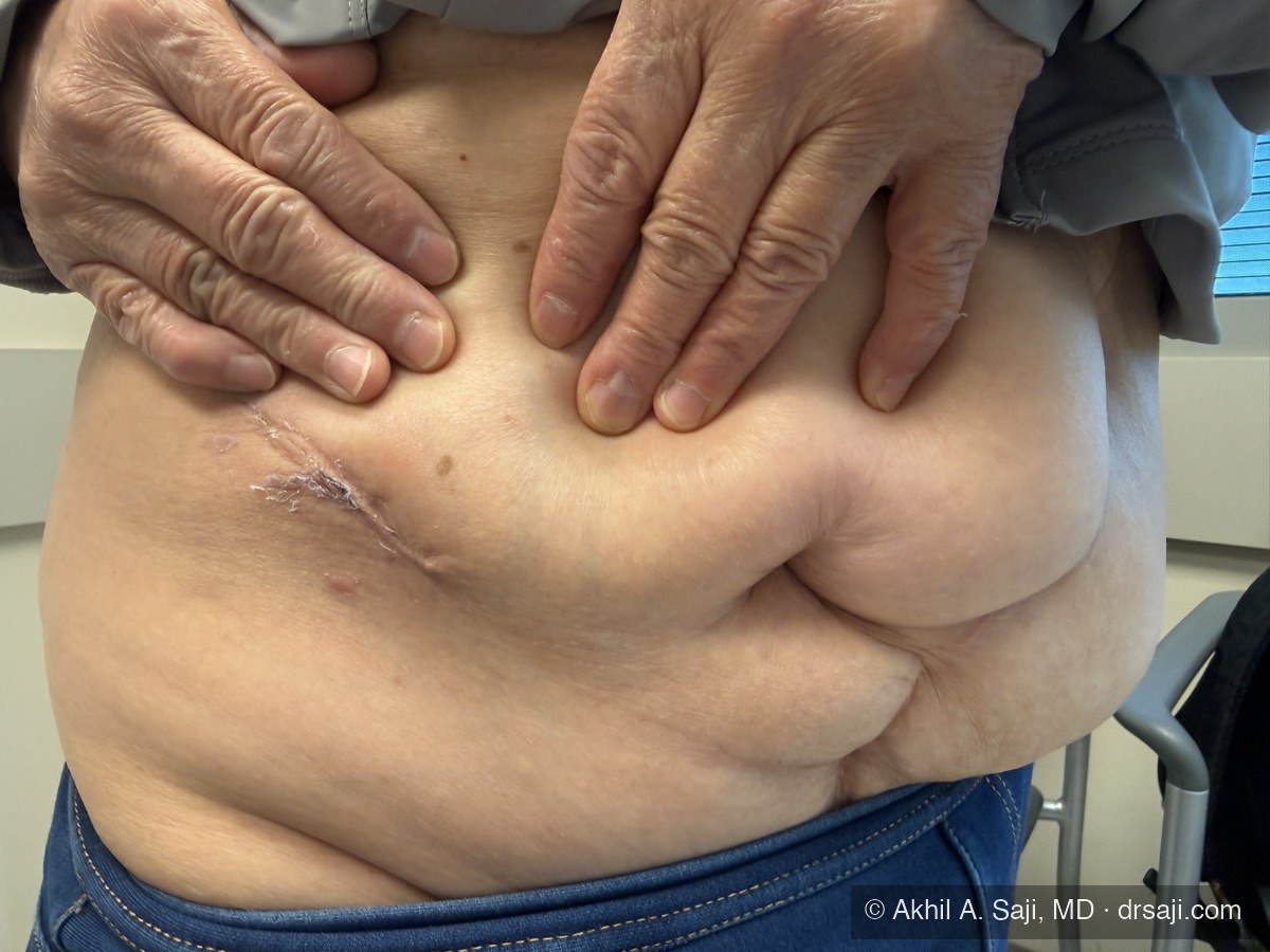 The same incision at the day-10 follow-up visit, already faded to a thin line